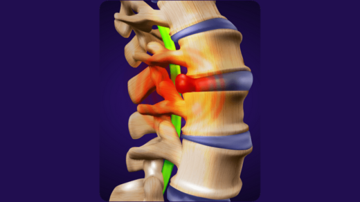 disc bulge treatment